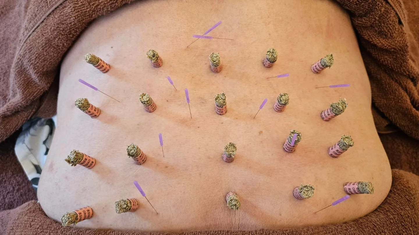 腰痛 鍼&お灸