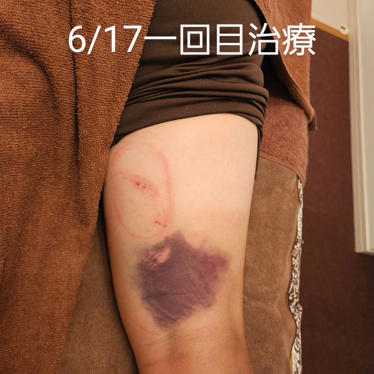肉離れの治療2回目